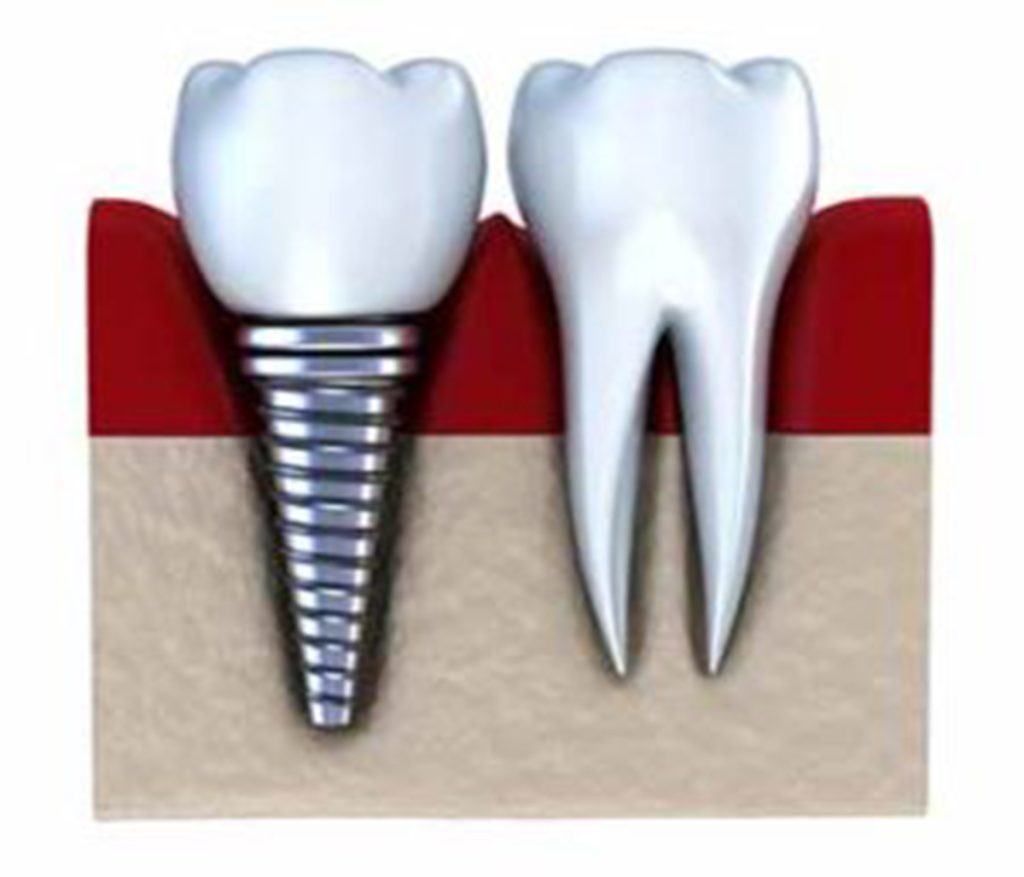 Maine Zirconia Dental Implants Zirconia Dental Implants Maine