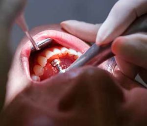 The root canal procedure