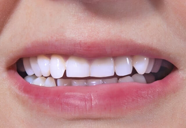 http://After%20Image%20Case%206