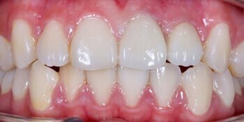 Tooth Crown After Results