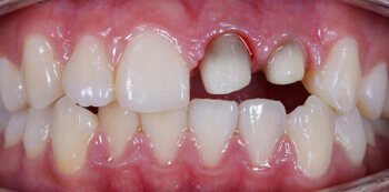 Tooth Crown Before Results