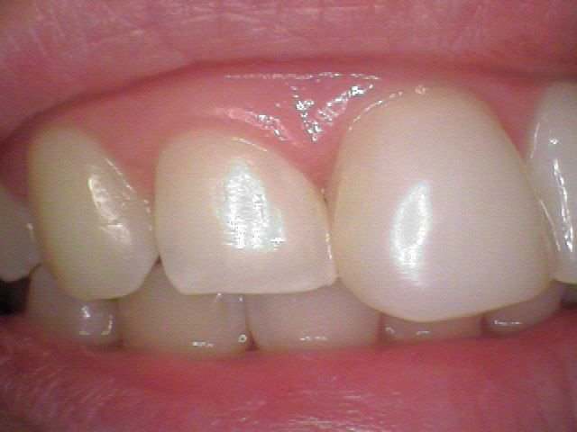 Befor Ging