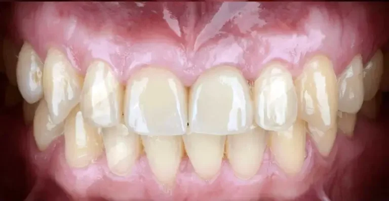 Dental Implants Before And After Single Tooth