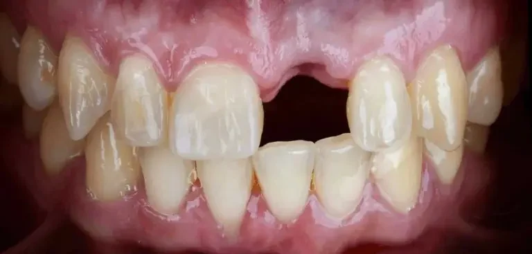Dental Implants Before And After Single Tooth